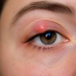 À quoi est dû un orgelet ?