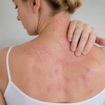 A quoi est du le psoriasis : causes possibles et pistes naturelles