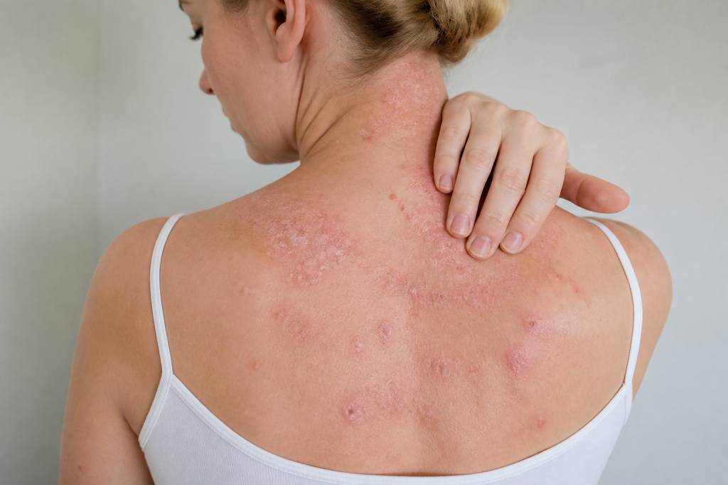 A quoi est du le psoriasis : causes possibles et pistes naturelles