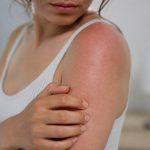 Combien de temps dur une allergie au soleil ?