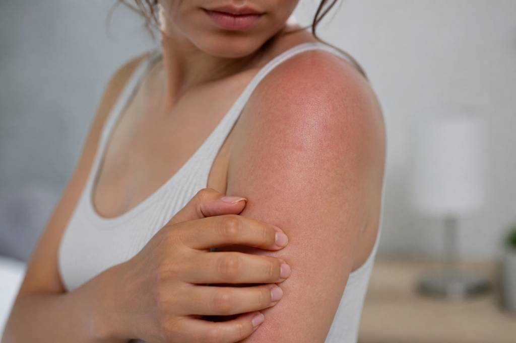 Combien de temps dur une allergie au soleil ?