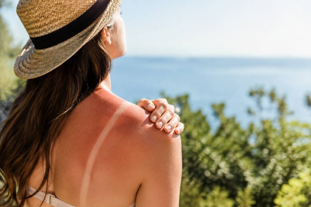 Brûlure au soleil : que faire et quelles plantes découvrir ?