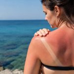 Brûlure coup de soleil : que faire pour apaiser la peau ?