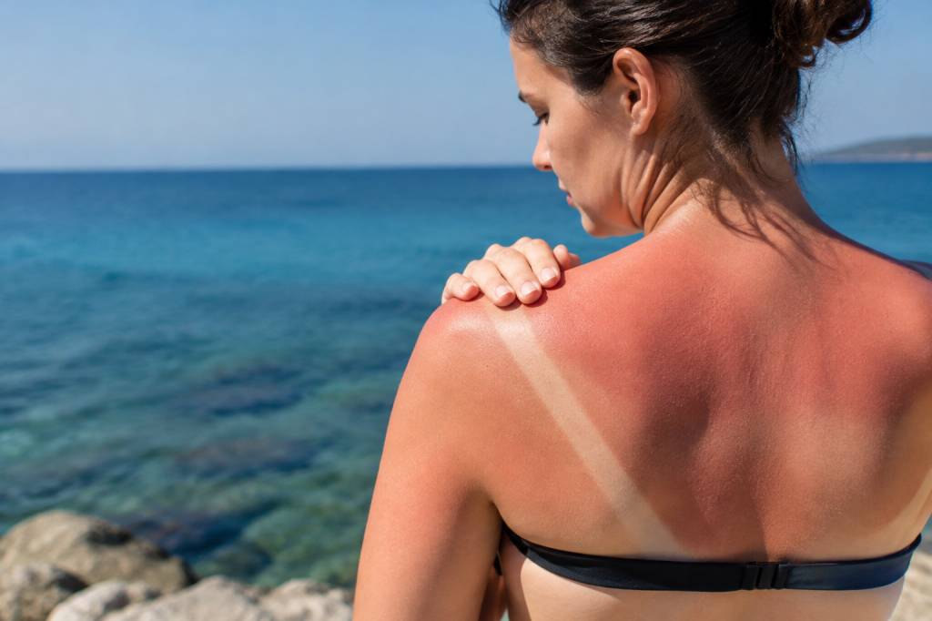 Brûlure coup de soleil : que faire pour apaiser la peau ?